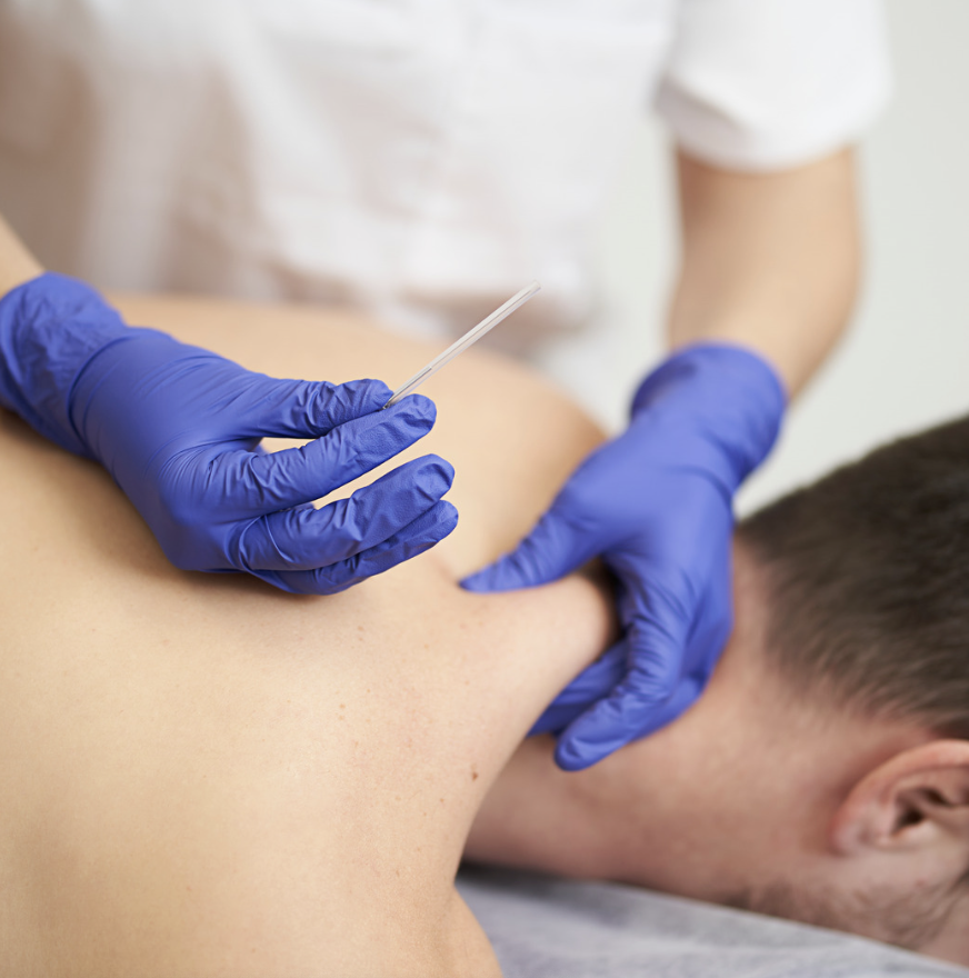 fysio - dry needling